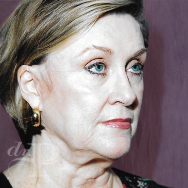 Case--30077 | Before Skin Rejuvenation 3