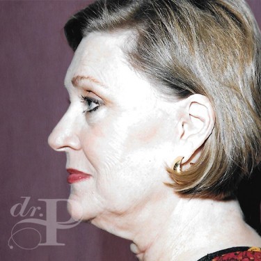 Case--30077 | Before Skin Rejuvenation 2