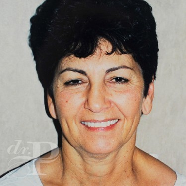 Case--29908 | Before Eyelid Surgery (Blepharoplasty) 1