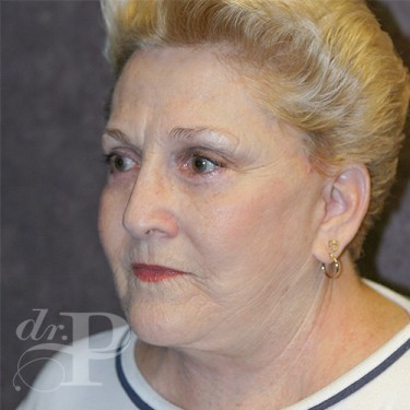 Case--29863 | After Eyelid Surgery (Blepharoplasty) 2