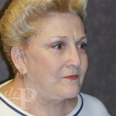Case--29863 | After Eyelid Surgery (Blepharoplasty) 4