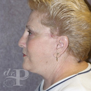 Case--29863 | After Eyelid Surgery (Blepharoplasty) 3