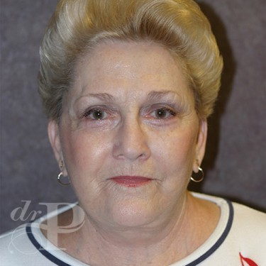 Case--29863 | After Eyelid Surgery (Blepharoplasty) 1