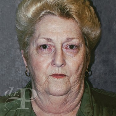 Case--29863 | Before Eyelid Surgery (Blepharoplasty) 1