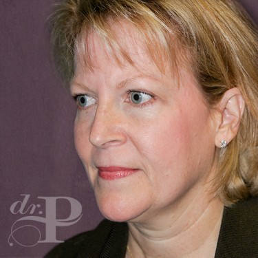 Case--29762 | After Eyelid Surgery (Blepharoplasty) 2