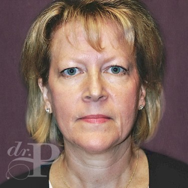 Case--29762 | Before Eyelid Surgery (Blepharoplasty) 1