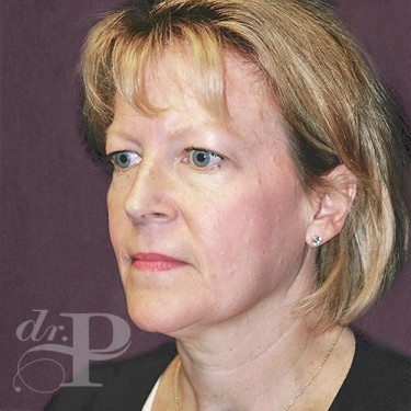 Case--29762 | Before Eyelid Surgery (Blepharoplasty) 2
