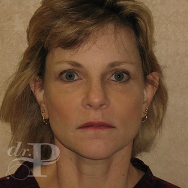 Case--30233 | After Eyelid Surgery (Blepharoplasty) 1