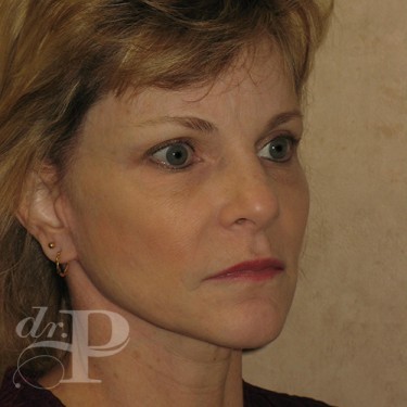 Case--30233 | After Eyelid Surgery (Blepharoplasty) 4