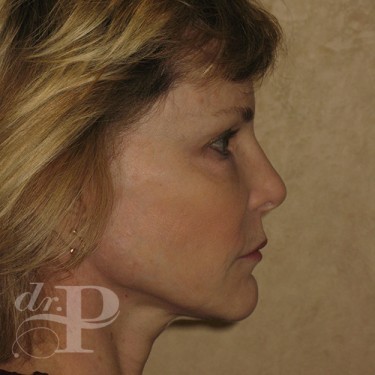 Case--30233 | After Eyelid Surgery (Blepharoplasty) 5