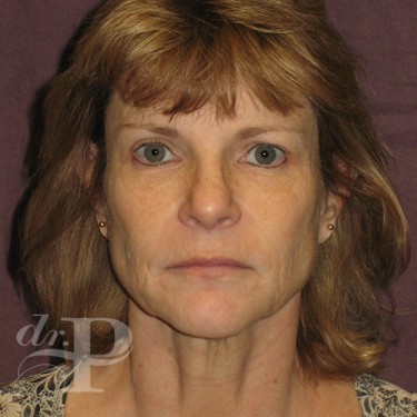 Case--30233 | Before Eyelid Surgery (Blepharoplasty) 1