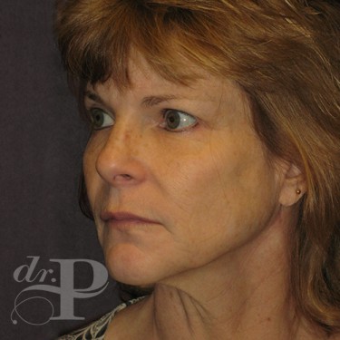 Case--30233 | Before Eyelid Surgery (Blepharoplasty) 2
