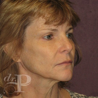Case--30233 | Before Eyelid Surgery (Blepharoplasty) 4
