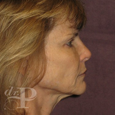 Case--30233 | Before Eyelid Surgery (Blepharoplasty) 5