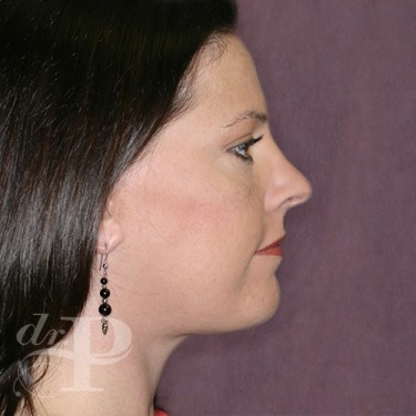 Case--29744 | After Eyelid Surgery (Blepharoplasty) 5