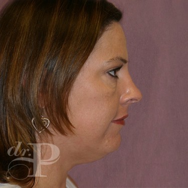 Case--29744 | Before Eyelid Surgery (Blepharoplasty) 5