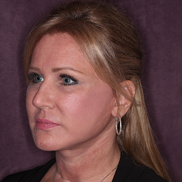 Case--34656 | After Skin Rejuvenation 3
