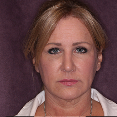 Case--34656 | Before Skin Rejuvenation 1