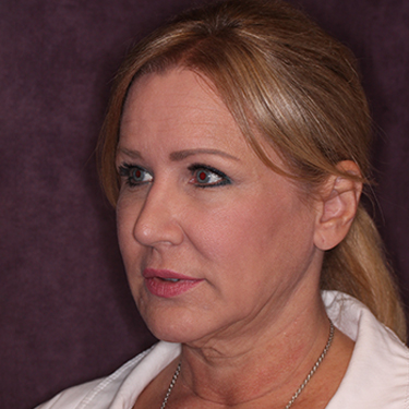 Case--34656 | Before Skin Rejuvenation 3