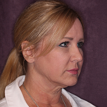 Case--34656 | Before Skin Rejuvenation 2