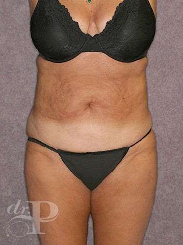 Case--30302 | Before True Form Tummy Tuck® with Lower Body Lift (Buttock Lift) 1