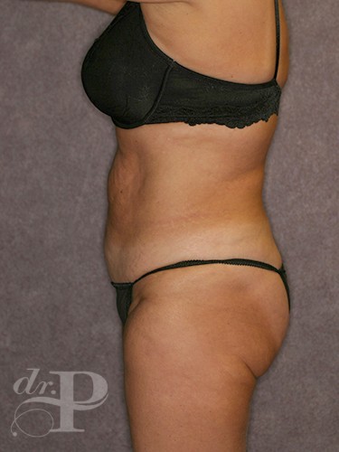 Case--30298 | Before Lower Body Lift (Buttock Lift) 3