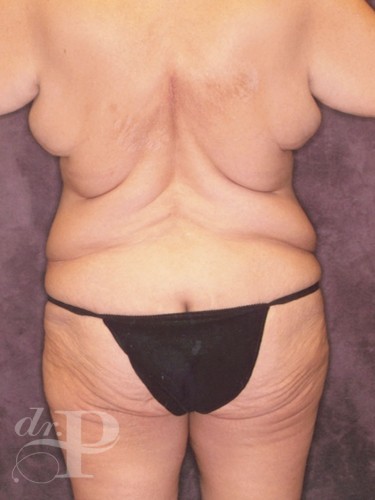Case--30363 | Before Lower Body Lift (Buttock Lift) 3