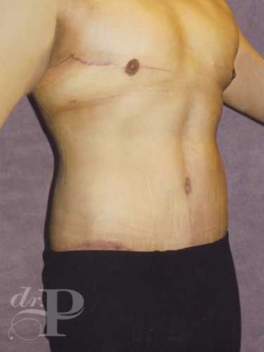 Case--1508 | After True Form Tummy Tuck® for Men 3