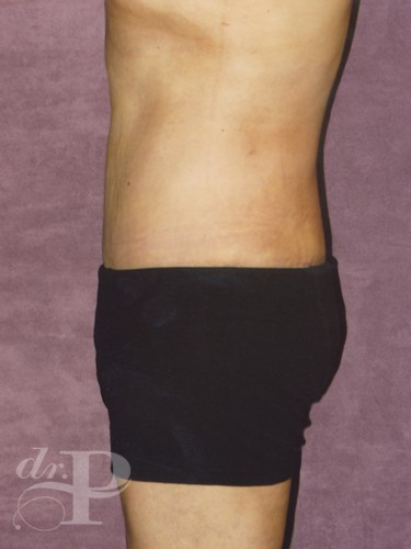 Case--1508 | After True Form Tummy Tuck® for Men 2