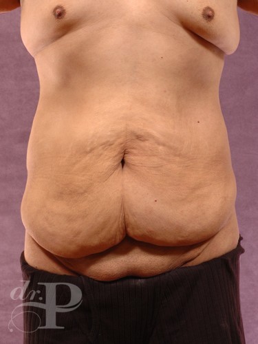 Case--1508 | Before True Form Tummy Tuck® for Men 1