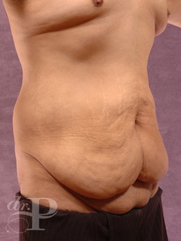 Case--1508 | Before True Form Tummy Tuck® for Men 3
