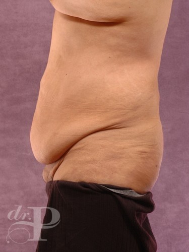 Case--1508 | Before True Form Tummy Tuck® for Men 2