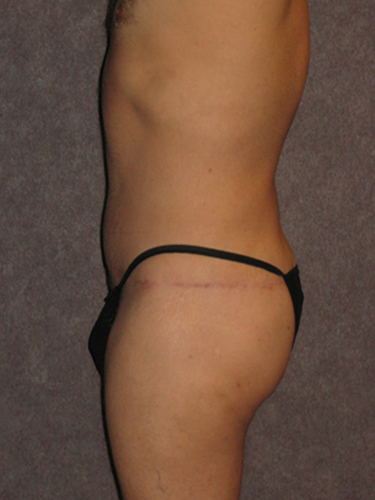 Case--33112 | After True Form Tummy Tuck® for Men 3