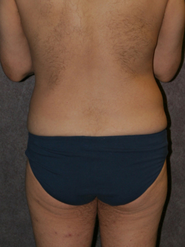 Case--33112 | Before True Form Tummy Tuck® for Men 4