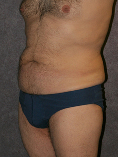 Case--33112 | Before True Form Tummy Tuck® for Men 2