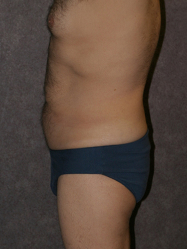 Case--33112 | Before True Form Tummy Tuck® for Men 3