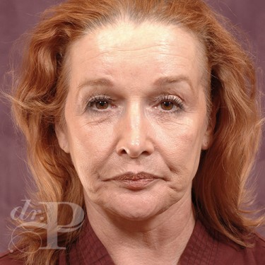 Case--29841 | Before Eyelid Surgery (Blepharoplasty) 1