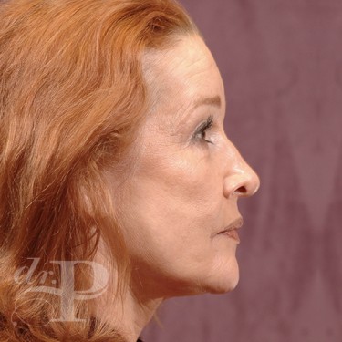 Case--29841 | Before Eyelid Surgery (Blepharoplasty) 5