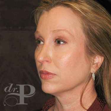 Case--29796 | After Eyelid Surgery (Blepharoplasty) 2