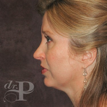 Case--29796 | Before Eyelid Surgery (Blepharoplasty) 3