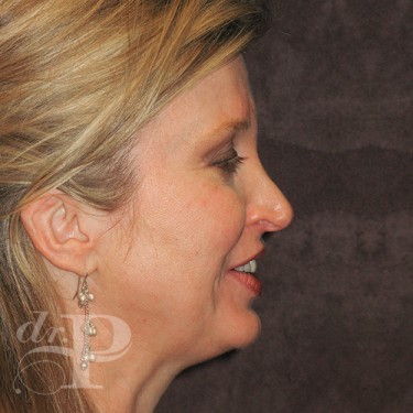 Case--29796 | Before Eyelid Surgery (Blepharoplasty) 5