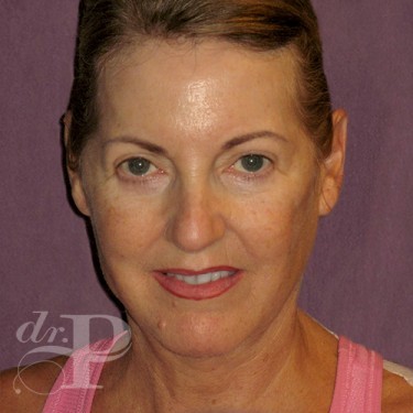 Case--29547 | After Eyelid Surgery (Blepharoplasty) 1
