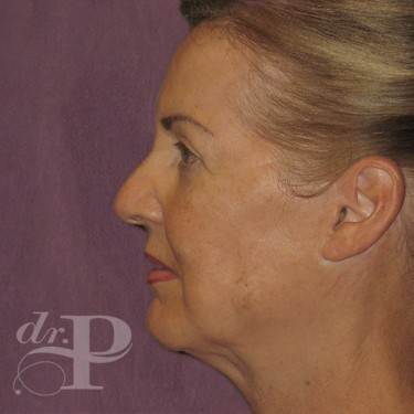 Case--29547 | After Eyelid Surgery (Blepharoplasty) 3