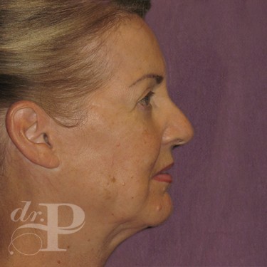 Case--29547 | After Eyelid Surgery (Blepharoplasty) 5