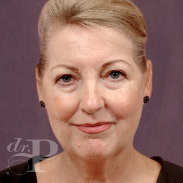 Case--29547 | Before Eyelid Surgery (Blepharoplasty) 1
