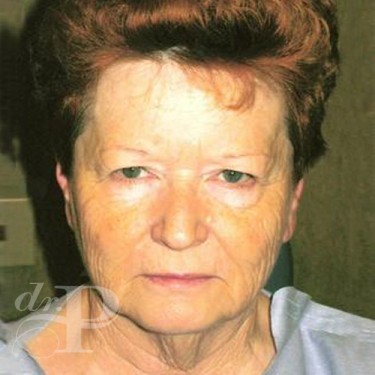 Case--30202 | Before Eyelid Surgery (Blepharoplasty) 1