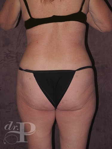 Case--29705 | After Tummy Tuck - Corrective/Revision 4