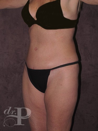 Case--29705 | After Tummy Tuck - Corrective/Revision 2