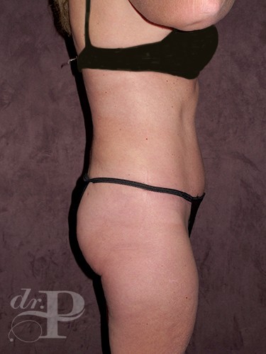 Case--29705 | After Tummy Tuck - Corrective/Revision 3