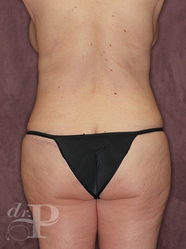 Case--1060 | After True Form Tummy Tuck® 4